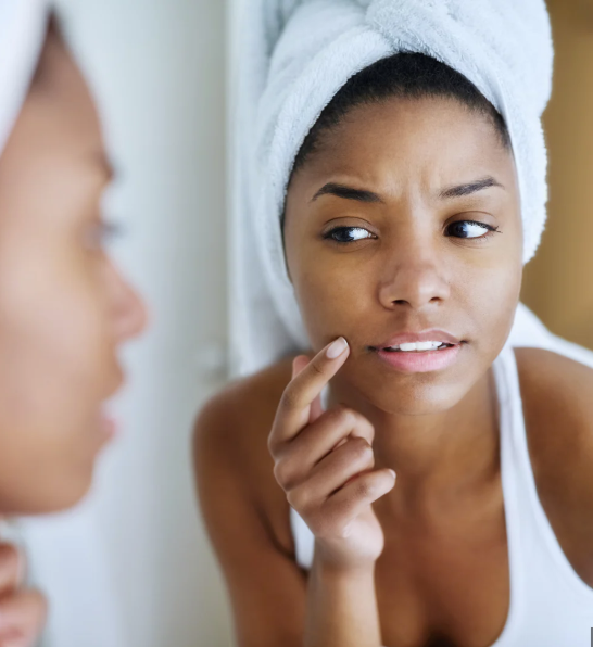 Why the Holidays Are Actually the Best Time to Tackle Acne